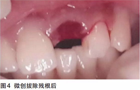 前牙即刻種植并個性化基臺美學(xué)修復(fù)