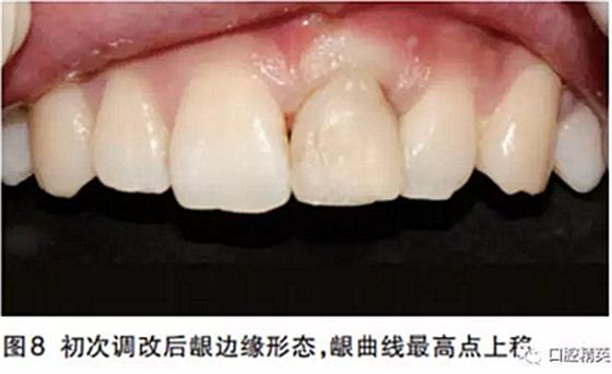 前牙即刻種植并個性化基臺美學(xué)修復(fù)