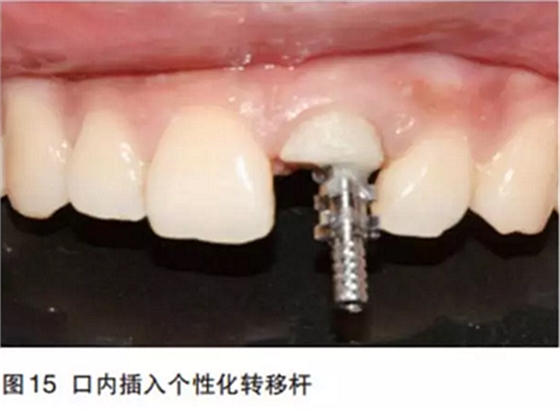 前牙即刻種植并個性化基臺美學(xué)修復(fù)