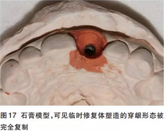 前牙即刻種植并個性化基臺美學(xué)修復(fù)