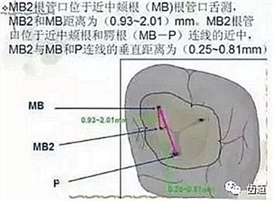 根管治療常見的難點與解決方案 根管治療常見的難點與解決方案