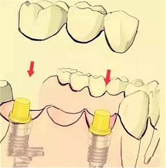 【牙齒種植】健康牙齒&ldquo;種&rdquo;出來