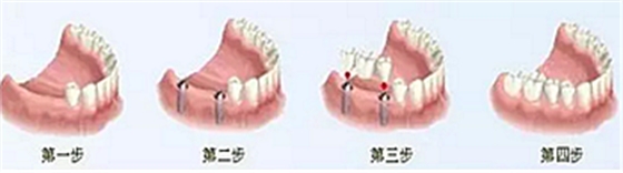 【牙齒種植】健康牙齒&ldquo;種&rdquo;出來
