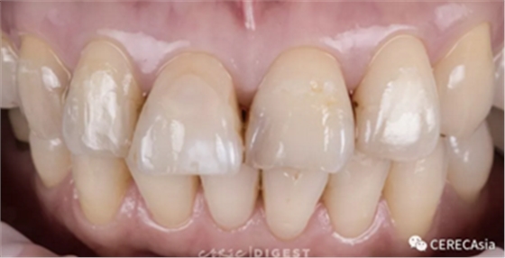 擁有瓷塊選擇權(quán)，是負(fù)擔(dān)還是自由？