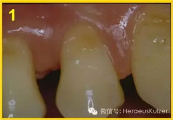 簡單治療——格魯瑪脫敏劑的應用 簡單治療——格魯瑪脫敏劑的應用