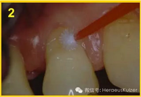 簡單治療——格魯瑪脫敏劑的應用 簡單治療——格魯瑪脫敏劑的應用