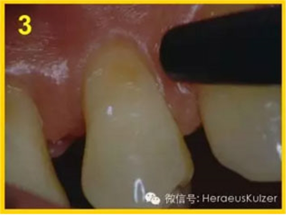 簡單治療——格魯瑪脫敏劑的應用 簡單治療——格魯瑪脫敏劑的應用