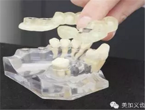 牙技術(shù)丨牙科種植導(dǎo)板在臨床中的應(yīng)用 牙技術(shù)丨牙科種植導(dǎo)板在臨床中的應(yīng)用
