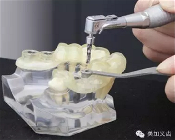 牙技術(shù)丨牙科種植導(dǎo)板在臨床中的應(yīng)用 牙技術(shù)丨牙科種植導(dǎo)板在臨床中的應(yīng)用