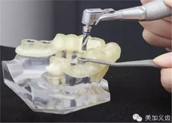 牙技術(shù)丨牙科種植導(dǎo)板在臨床中的應(yīng)用 牙技術(shù)丨牙科種植導(dǎo)板在臨床中的應(yīng)用