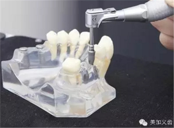 牙技術(shù)丨牙科種植導(dǎo)板在臨床中的應(yīng)用 牙技術(shù)丨牙科種植導(dǎo)板在臨床中的應(yīng)用