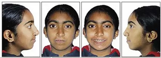 正畸文獻(xiàn)閱讀--單側(cè)唇腭裂患者的多學(xué)科綜合序列治療 正畸文獻(xiàn)閱讀--單側(cè)唇腭裂患者的多學(xué)科綜合序列治療