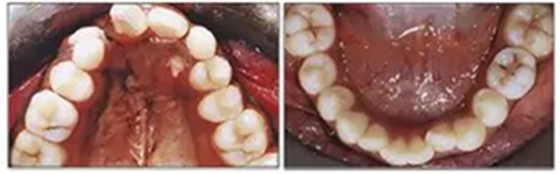 正畸文獻(xiàn)閱讀--單側(cè)唇腭裂患者的多學(xué)科綜合序列治療 正畸文獻(xiàn)閱讀--單側(cè)唇腭裂患者的多學(xué)科綜合序列治療
