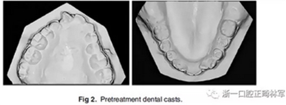 正畸文獻(xiàn)閱讀--單側(cè)唇腭裂患者的多學(xué)科綜合序列治療 正畸文獻(xiàn)閱讀--單側(cè)唇腭裂患者的多學(xué)科綜合序列治療
