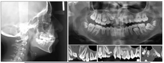 正畸文獻(xiàn)閱讀--單側(cè)唇腭裂患者的多學(xué)科綜合序列治療 正畸文獻(xiàn)閱讀--單側(cè)唇腭裂患者的多學(xué)科綜合序列治療
