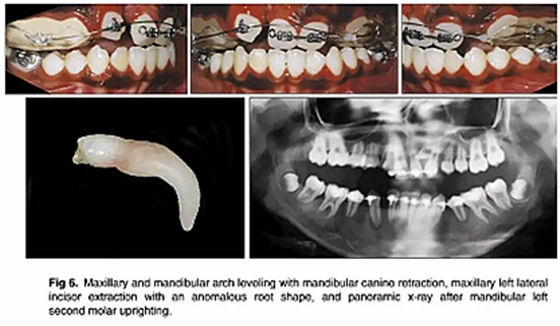 正畸文獻(xiàn)閱讀--單側(cè)唇腭裂患者的多學(xué)科綜合序列治療 正畸文獻(xiàn)閱讀--單側(cè)唇腭裂患者的多學(xué)科綜合序列治療