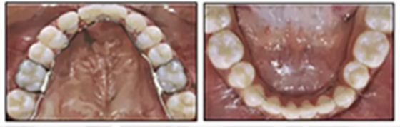 正畸文獻(xiàn)閱讀--單側(cè)唇腭裂患者的多學(xué)科綜合序列治療 正畸文獻(xiàn)閱讀--單側(cè)唇腭裂患者的多學(xué)科綜合序列治療