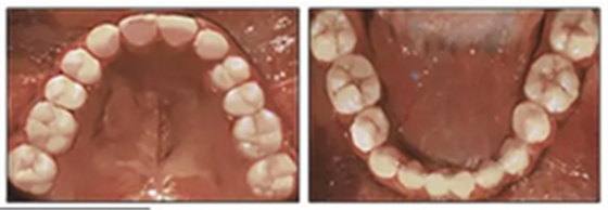 正畸文獻(xiàn)閱讀--單側(cè)唇腭裂患者的多學(xué)科綜合序列治療 正畸文獻(xiàn)閱讀--單側(cè)唇腭裂患者的多學(xué)科綜合序列治療