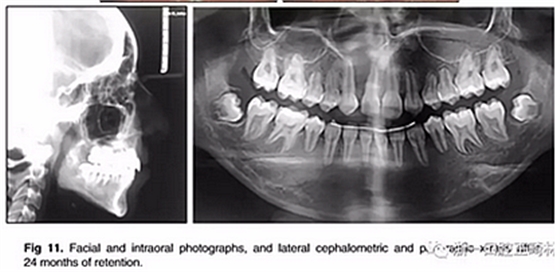 正畸文獻(xiàn)閱讀--單側(cè)唇腭裂患者的多學(xué)科綜合序列治療 正畸文獻(xiàn)閱讀--單側(cè)唇腭裂患者的多學(xué)科綜合序列治療