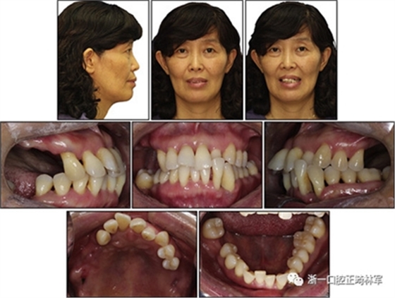 文獻優(yōu)秀正畸病例賞析--多顆牙齒缺失的牙周炎患者的跨學(xué)科綜合治療 文獻優(yōu)秀正畸病例賞析--多顆牙齒缺失的牙周炎患者的跨學(xué)科綜合治療