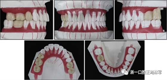 文獻優(yōu)秀正畸病例賞析--多顆牙齒缺失的牙周炎患者的跨學(xué)科綜合治療 文獻優(yōu)秀正畸病例賞析--多顆牙齒缺失的牙周炎患者的跨學(xué)科綜合治療