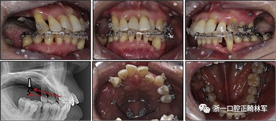 文獻優(yōu)秀正畸病例賞析--多顆牙齒缺失的牙周炎患者的跨學(xué)科綜合治療 文獻優(yōu)秀正畸病例賞析--多顆牙齒缺失的牙周炎患者的跨學(xué)科綜合治療
