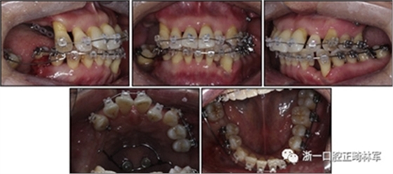 文獻優(yōu)秀正畸病例賞析--多顆牙齒缺失的牙周炎患者的跨學(xué)科綜合治療 文獻優(yōu)秀正畸病例賞析--多顆牙齒缺失的牙周炎患者的跨學(xué)科綜合治療