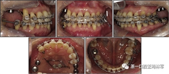 文獻優(yōu)秀正畸病例賞析--多顆牙齒缺失的牙周炎患者的跨學(xué)科綜合治療 文獻優(yōu)秀正畸病例賞析--多顆牙齒缺失的牙周炎患者的跨學(xué)科綜合治療