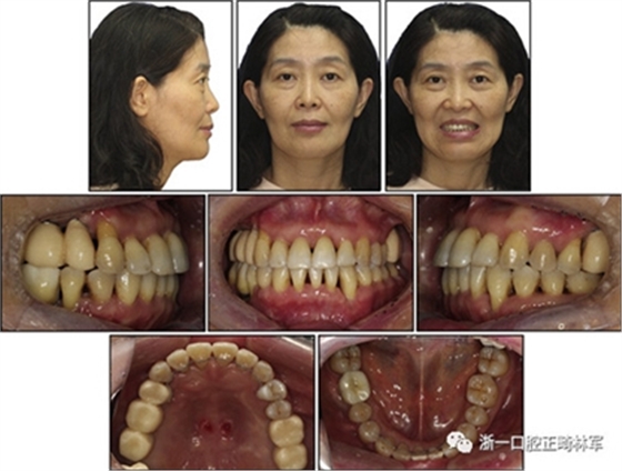 文獻優(yōu)秀正畸病例賞析--多顆牙齒缺失的牙周炎患者的跨學(xué)科綜合治療 文獻優(yōu)秀正畸病例賞析--多顆牙齒缺失的牙周炎患者的跨學(xué)科綜合治療