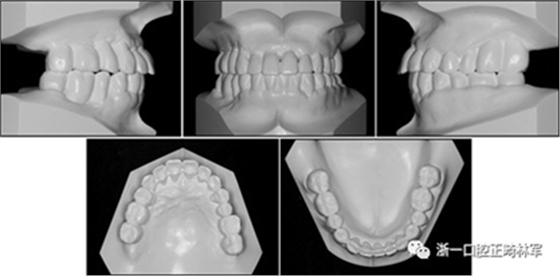 文獻優(yōu)秀正畸病例賞析--多顆牙齒缺失的牙周炎患者的跨學(xué)科綜合治療 文獻優(yōu)秀正畸病例賞析--多顆牙齒缺失的牙周炎患者的跨學(xué)科綜合治療