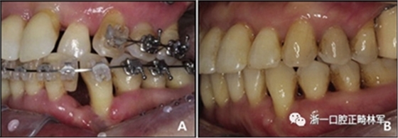 文獻優(yōu)秀正畸病例賞析--多顆牙齒缺失的牙周炎患者的跨學(xué)科綜合治療 文獻優(yōu)秀正畸病例賞析--多顆牙齒缺失的牙周炎患者的跨學(xué)科綜合治療