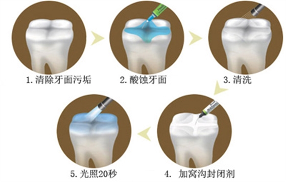 窩溝封閉丨孩子牙齒的&ldquo;鎧甲勇士&rdquo;