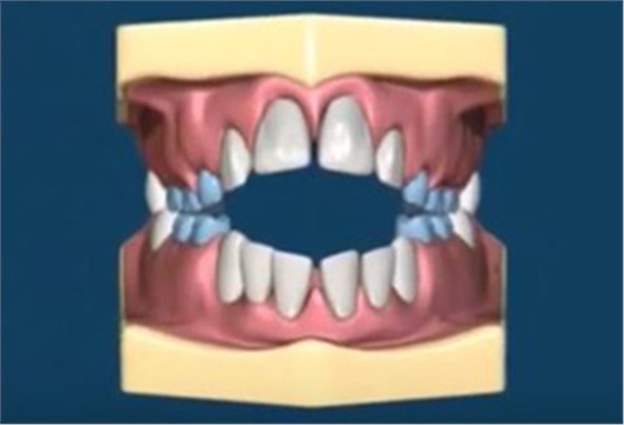 12歲前必須處理的20種兒童牙頜畸形【口腔科普】 12歲前必須處理的20種兒童牙頜畸形【口腔科普】