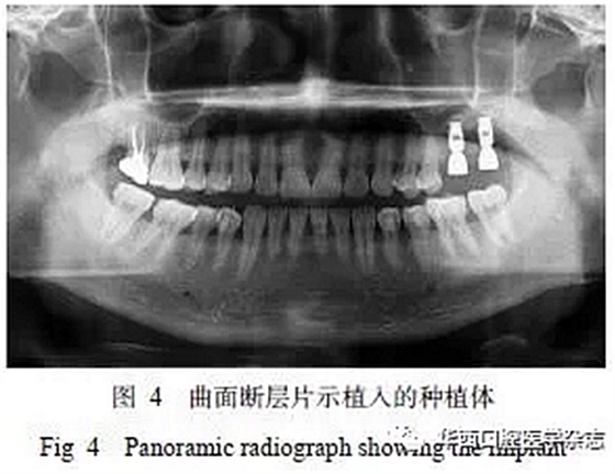 利用壓膜式活動矯治器壓入下頜第一、第二磨牙1例
