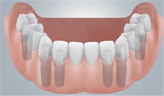 無牙頜種植修復(fù)的檢查與設(shè)計——施斌教授 無牙頜種植修復(fù)的檢查與設(shè)計——施斌教授