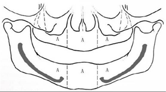 無牙頜種植修復(fù)的檢查與設(shè)計——施斌教授 無牙頜種植修復(fù)的檢查與設(shè)計——施斌教授