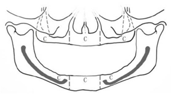 無牙頜種植修復(fù)的檢查與設(shè)計——施斌教授 無牙頜種植修復(fù)的檢查與設(shè)計——施斌教授