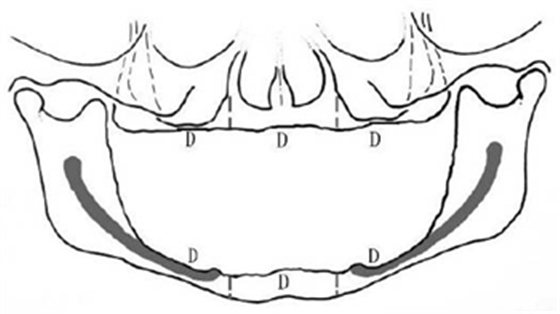 無牙頜種植修復(fù)的檢查與設(shè)計——施斌教授 無牙頜種植修復(fù)的檢查與設(shè)計——施斌教授