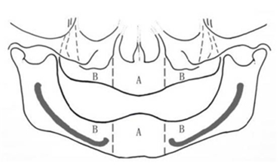 無牙頜種植修復(fù)的檢查與設(shè)計——施斌教授 無牙頜種植修復(fù)的檢查與設(shè)計——施斌教授