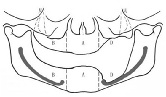 無牙頜種植修復(fù)的檢查與設(shè)計——施斌教授 無牙頜種植修復(fù)的檢查與設(shè)計——施斌教授