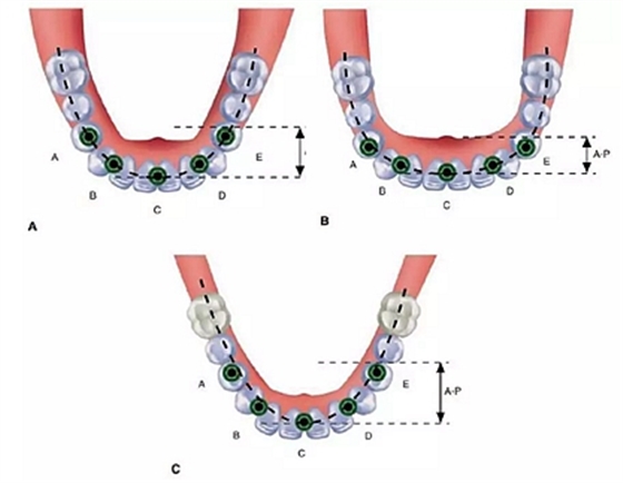 無牙頜種植修復(fù)的檢查與設(shè)計——施斌教授 無牙頜種植修復(fù)的檢查與設(shè)計——施斌教授