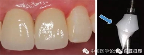 手把手教你做種植軟組織成形 手把手教你做種植軟組織成形