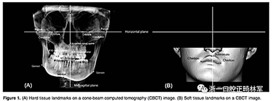 正畸文獻(xiàn)閱讀--III類面部不對(duì)稱患者在正畸掩飾性治療、單頜手術(shù)、雙頜手術(shù)后的唇線改變：初步研究