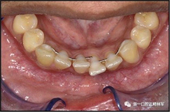 正畸文獻(xiàn)閱讀--固定舌側(cè)保持器作用下意外的牙齒移動(dòng) 正畸文獻(xiàn)閱讀--固定舌側(cè)保持器作用下意外的牙齒移動(dòng)