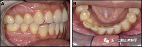 正畸文獻(xiàn)閱讀--固定舌側(cè)保持器作用下意外的牙齒移動(dòng) 正畸文獻(xiàn)閱讀--固定舌側(cè)保持器作用下意外的牙齒移動(dòng)