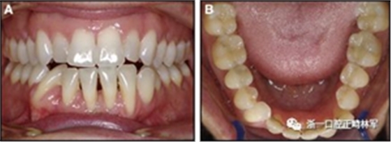 正畸文獻(xiàn)閱讀--固定舌側(cè)保持器作用下意外的牙齒移動(dòng) 正畸文獻(xiàn)閱讀--固定舌側(cè)保持器作用下意外的牙齒移動(dòng)