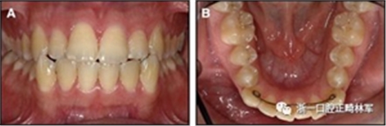 正畸文獻(xiàn)閱讀--固定舌側(cè)保持器作用下意外的牙齒移動(dòng) 正畸文獻(xiàn)閱讀--固定舌側(cè)保持器作用下意外的牙齒移動(dòng)