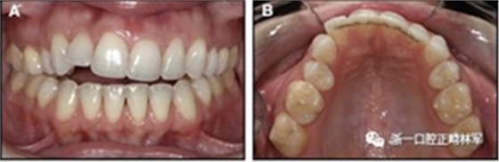 正畸文獻(xiàn)閱讀--固定舌側(cè)保持器作用下意外的牙齒移動(dòng) 正畸文獻(xiàn)閱讀--固定舌側(cè)保持器作用下意外的牙齒移動(dòng)