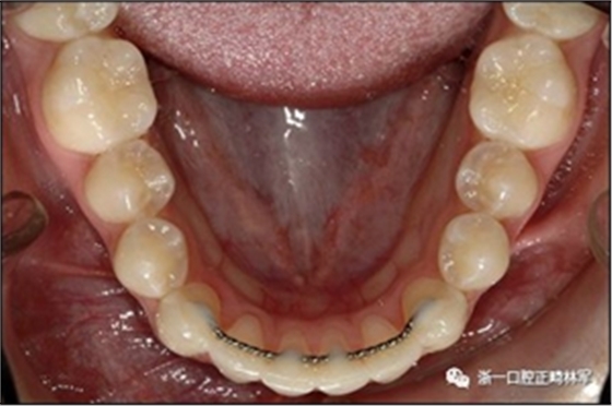 正畸文獻(xiàn)閱讀--固定舌側(cè)保持器作用下意外的牙齒移動(dòng) 正畸文獻(xiàn)閱讀--固定舌側(cè)保持器作用下意外的牙齒移動(dòng)
