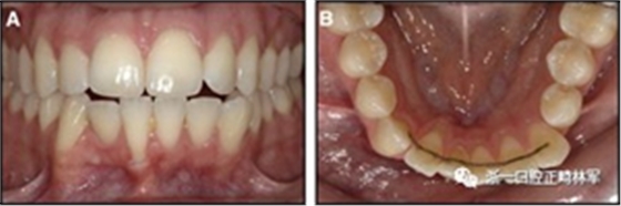 正畸文獻(xiàn)閱讀--固定舌側(cè)保持器作用下意外的牙齒移動(dòng) 正畸文獻(xiàn)閱讀--固定舌側(cè)保持器作用下意外的牙齒移動(dòng)